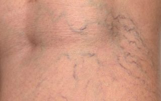 Spider Veins Removal