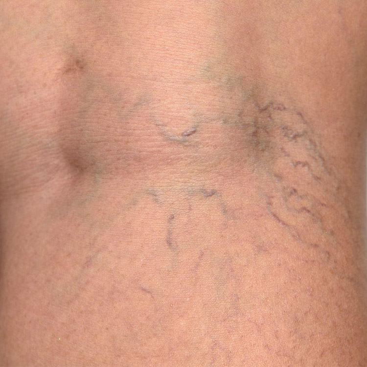 Spider Veins Removal
